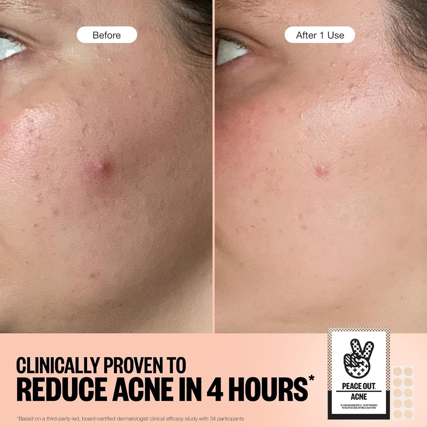 Acne Healing Dots Helps Clear Blemishes Overnight, Fast Acting Hydrocolloid Pimple Patches for Breakouts with Salicylic Acid, Retinol and Aloe Vera, Award Winning Skincare Solution 60 Count