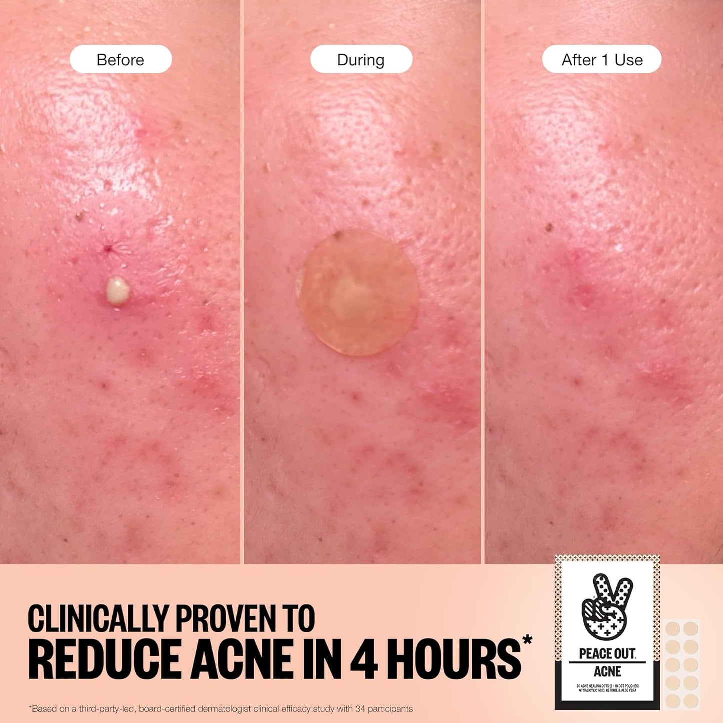 Acne Healing Dots Helps Clear Blemishes Overnight, Fast Acting Hydrocolloid Pimple Patches for Breakouts with Salicylic Acid, Retinol and Aloe Vera, Award Winning Skincare Solution 60 Count