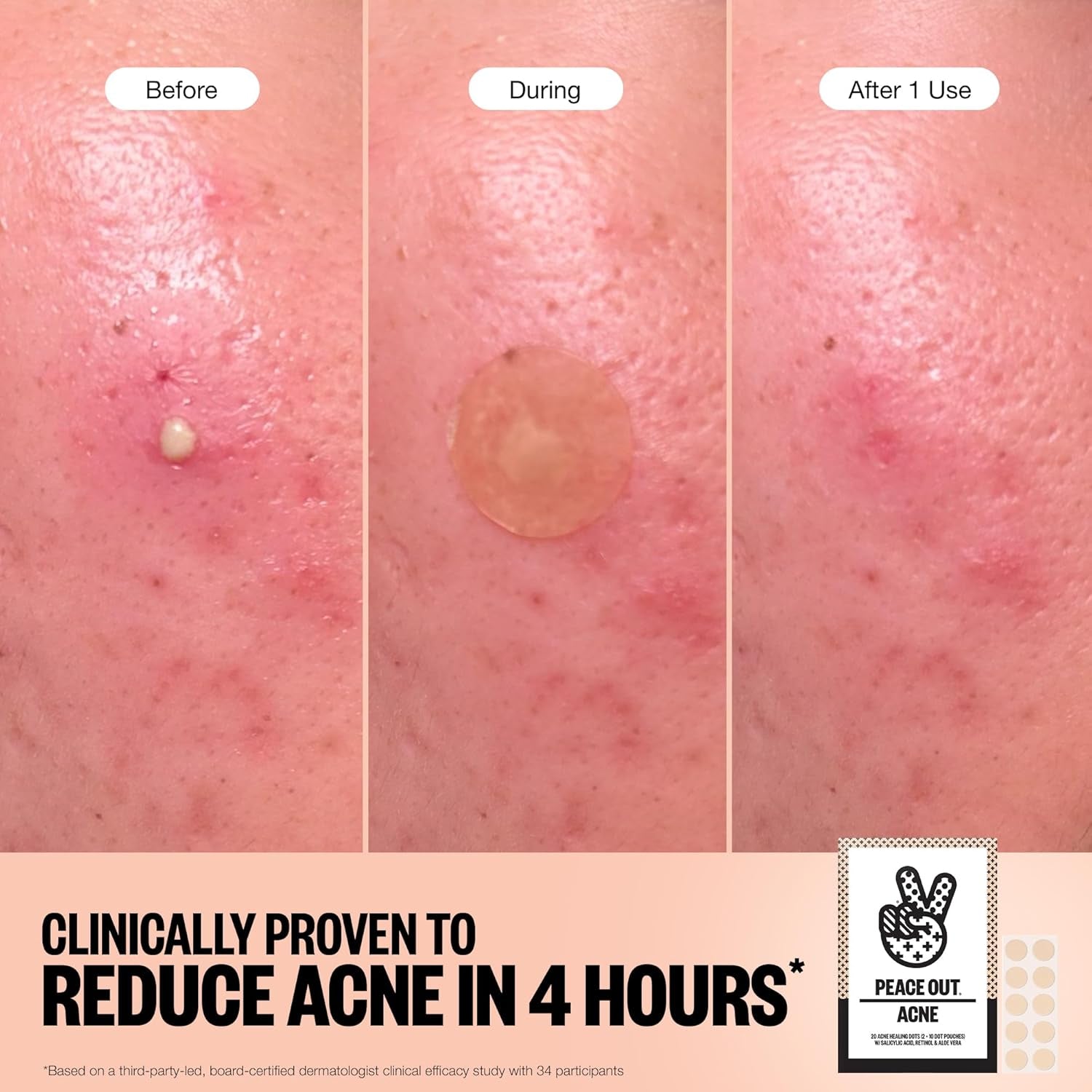 Acne Healing Dots Helps Clear Blemishes Overnight, Fast Acting Hydrocolloid Pimple Patches for Breakouts with Salicylic Acid, Retinol and Aloe Vera, Award Winning Skincare Solution 60 Count